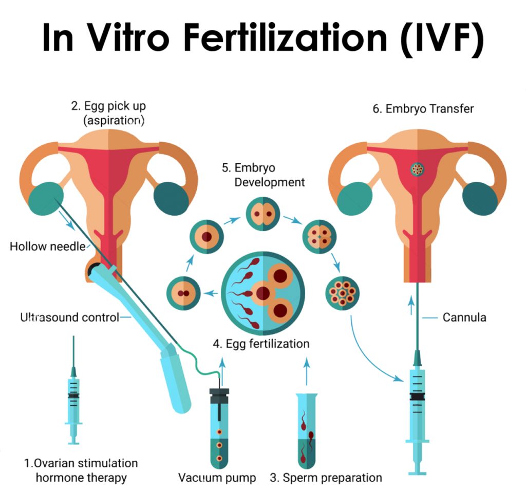 vitro fertilization