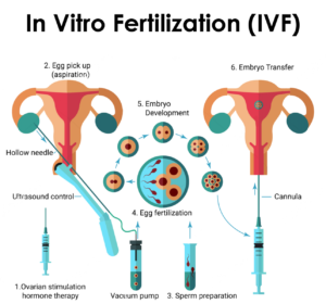 vitro fertilization